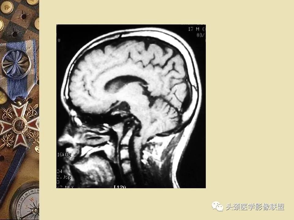 影像PPT - 【PPT】脑部病变的MRI诊断-97