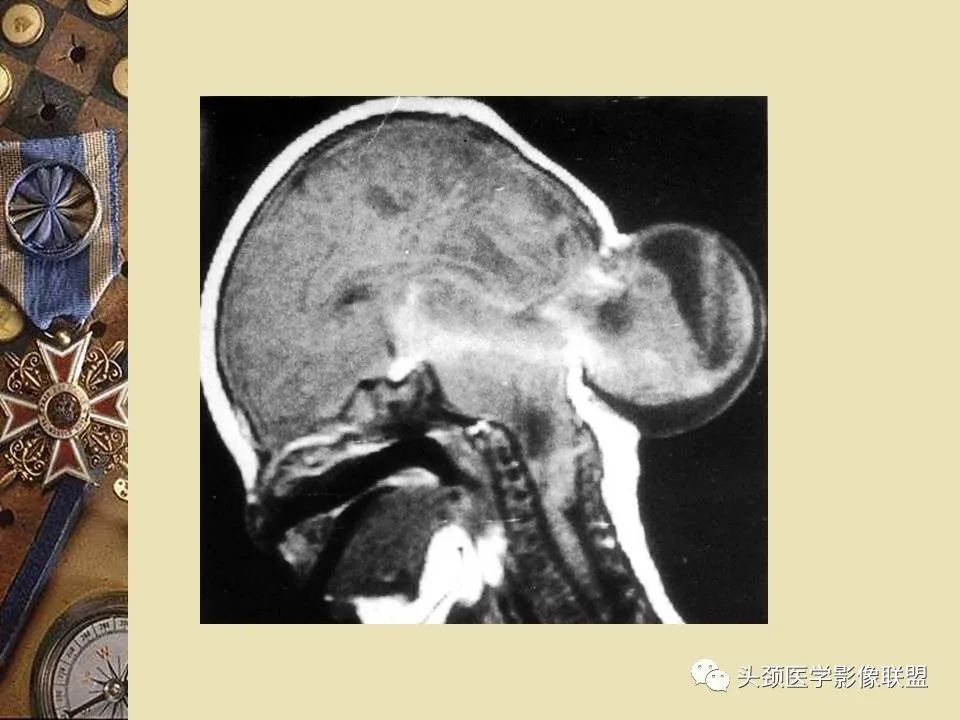 影像PPT - 【PPT】脑部病变的MRI诊断-99