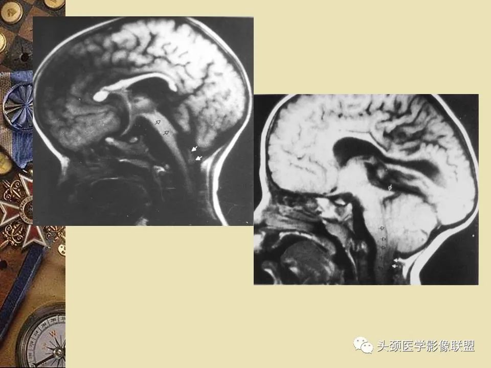 影像PPT - 【PPT】脑部病变的MRI诊断-98