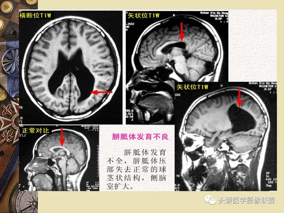 影像PPT - 【PPT】脑部病变的MRI诊断-101