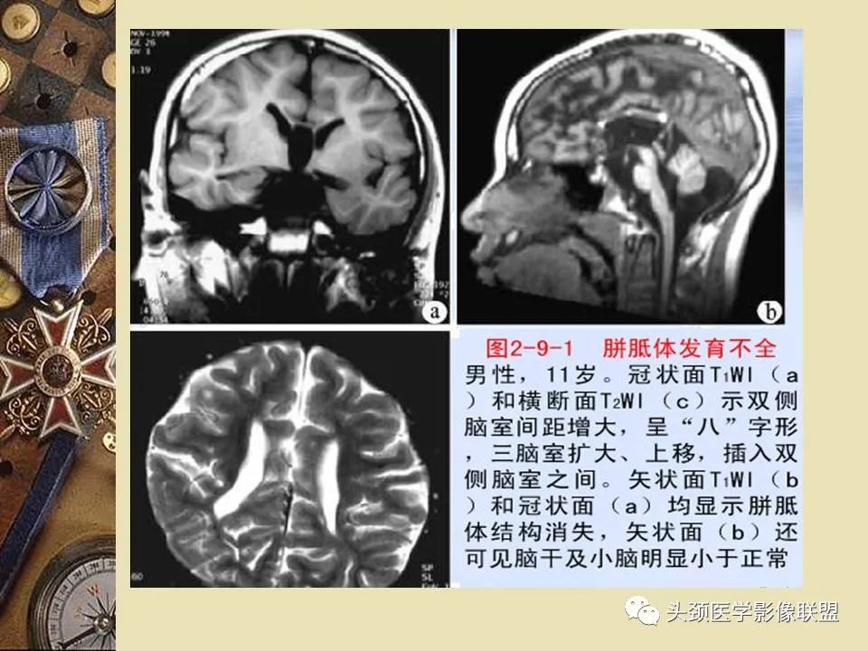 影像PPT - 【PPT】脑部病变的MRI诊断-102