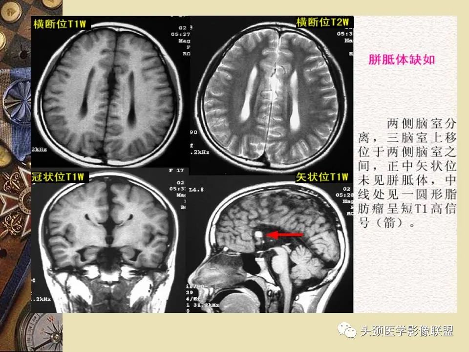 影像PPT - 【PPT】脑部病变的MRI诊断-103