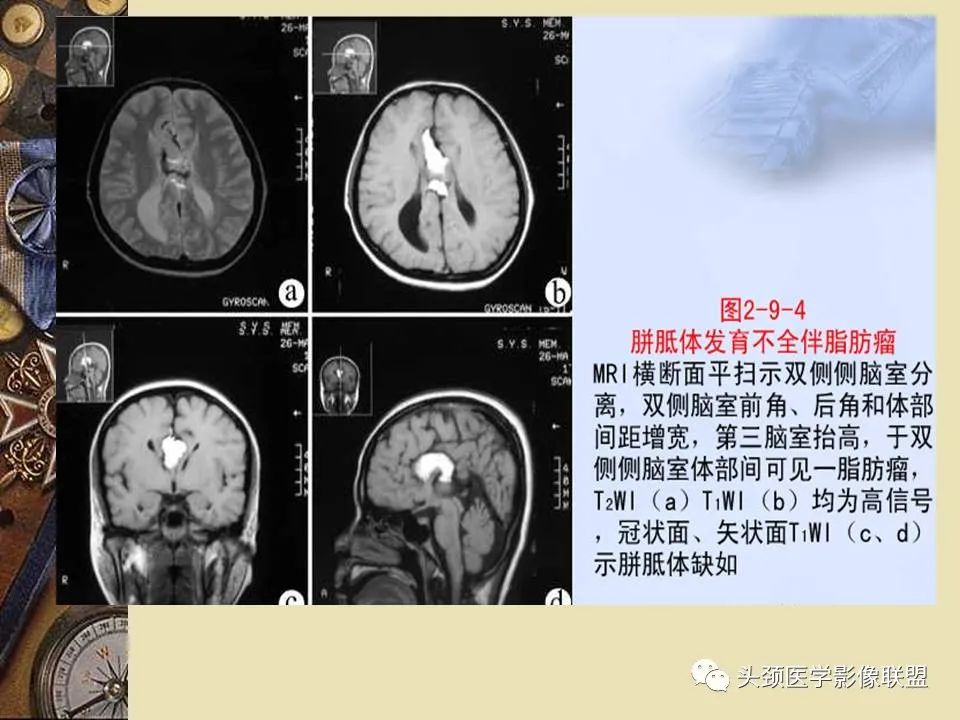 影像PPT - 【PPT】脑部病变的MRI诊断-104