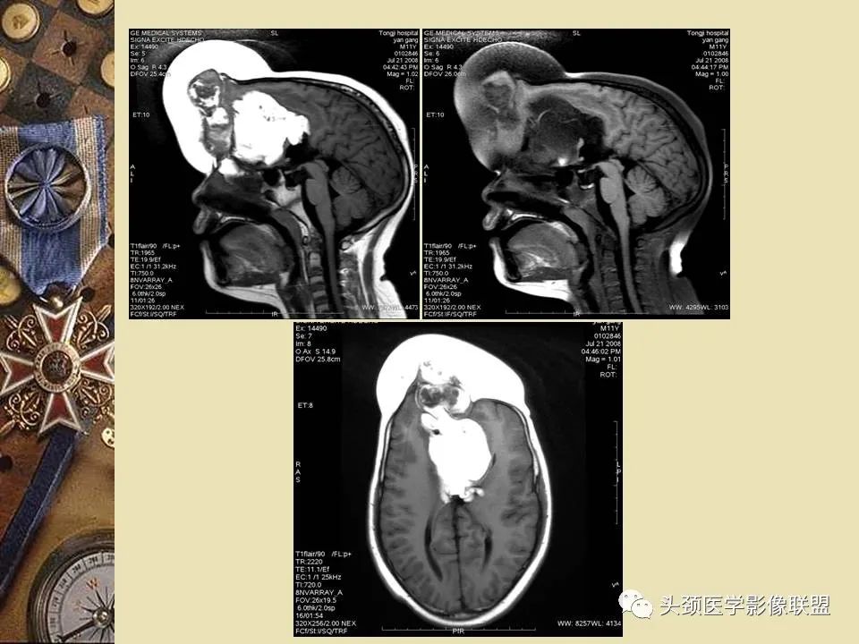影像PPT - 【PPT】脑部病变的MRI诊断-105