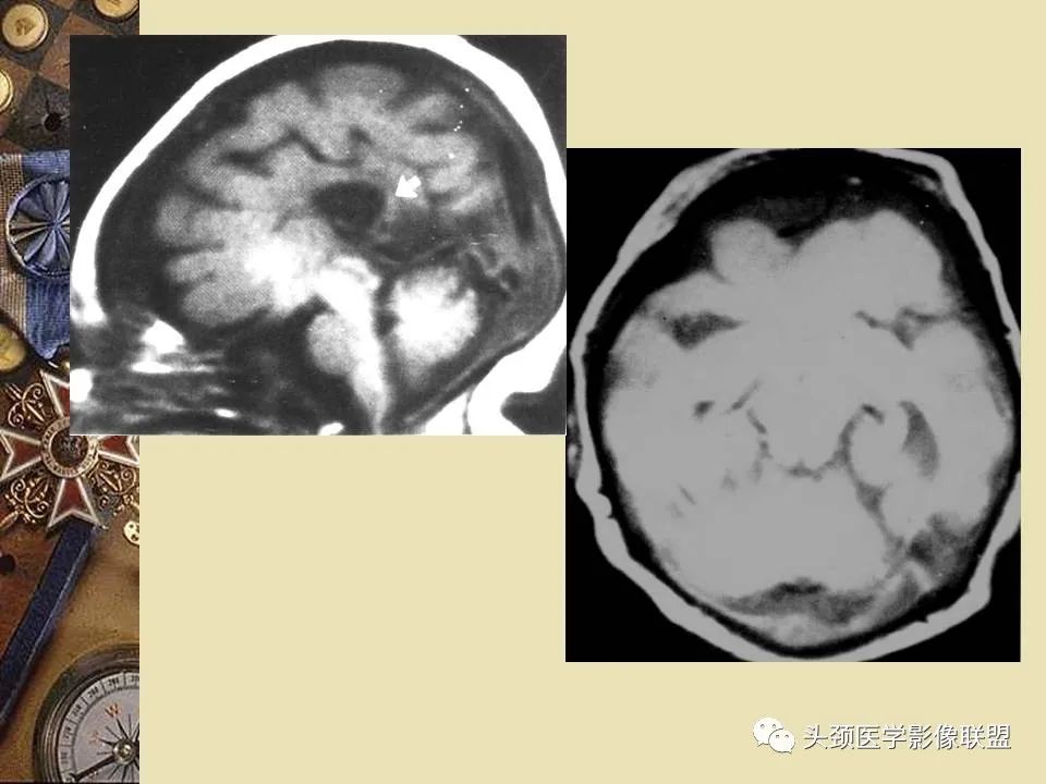 影像PPT - 【PPT】脑部病变的MRI诊断-110