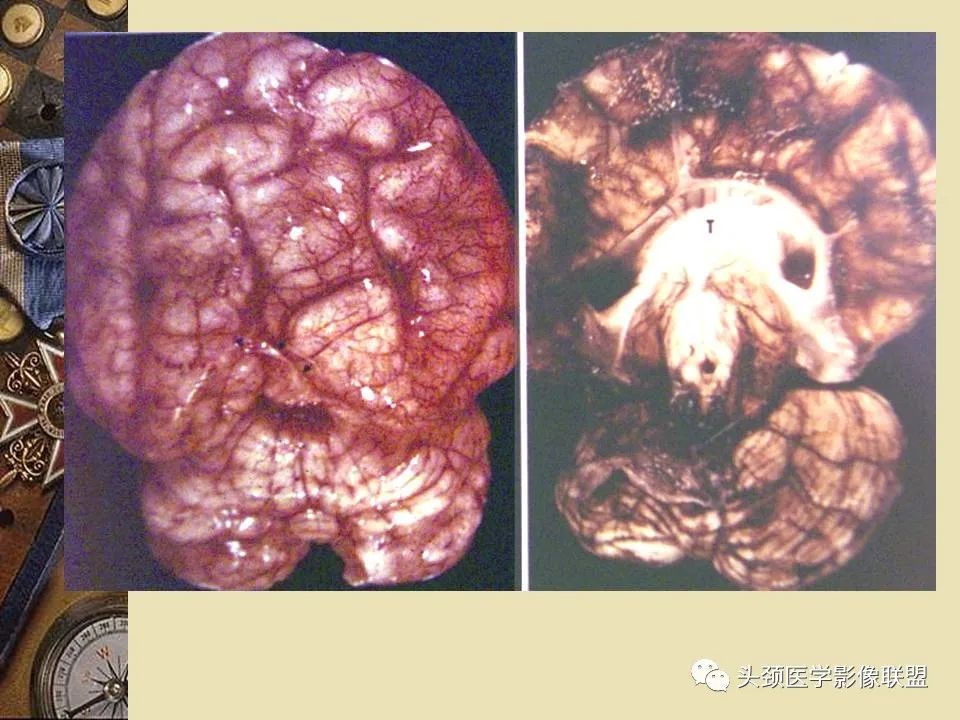 影像PPT - 【PPT】脑部病变的MRI诊断-109