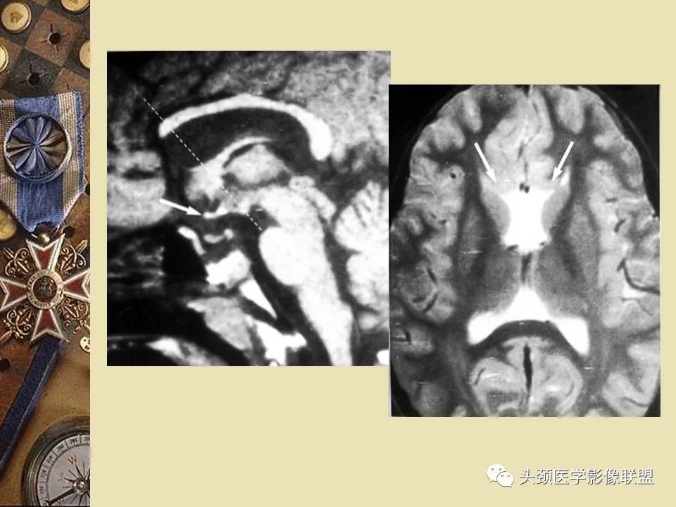 影像PPT - 【PPT】脑部病变的MRI诊断-111
