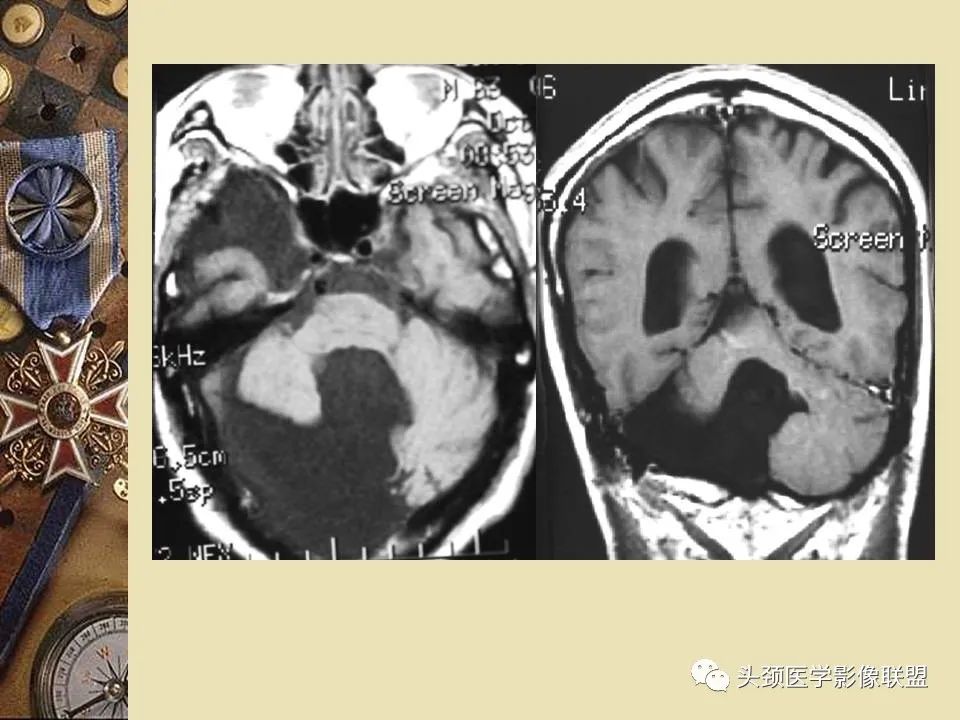 影像PPT - 【PPT】脑部病变的MRI诊断-113