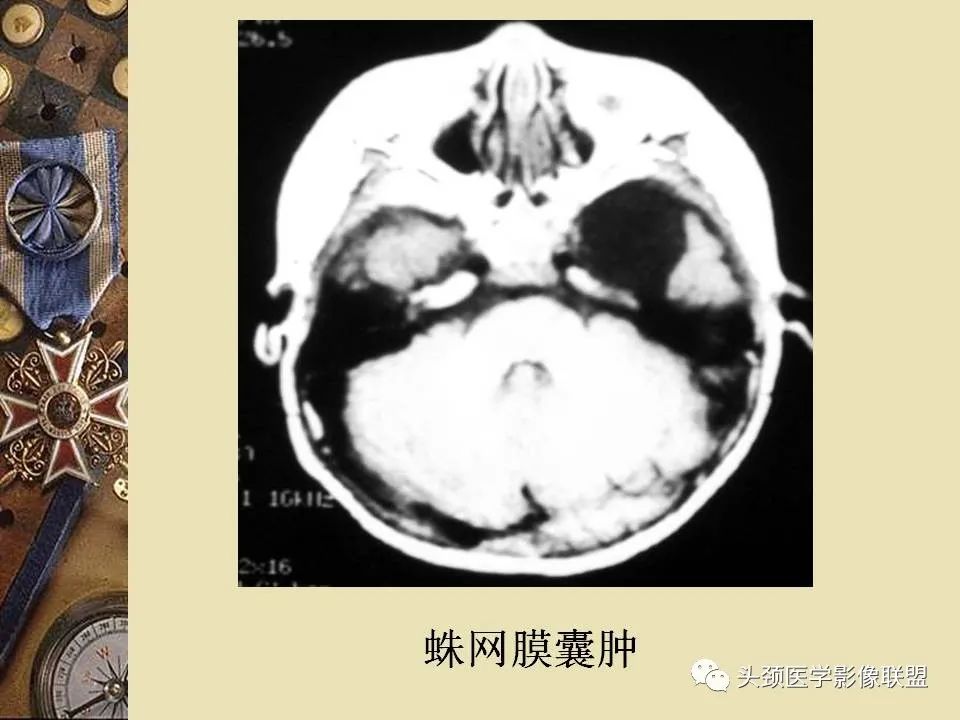 影像PPT - 【PPT】脑部病变的MRI诊断-116