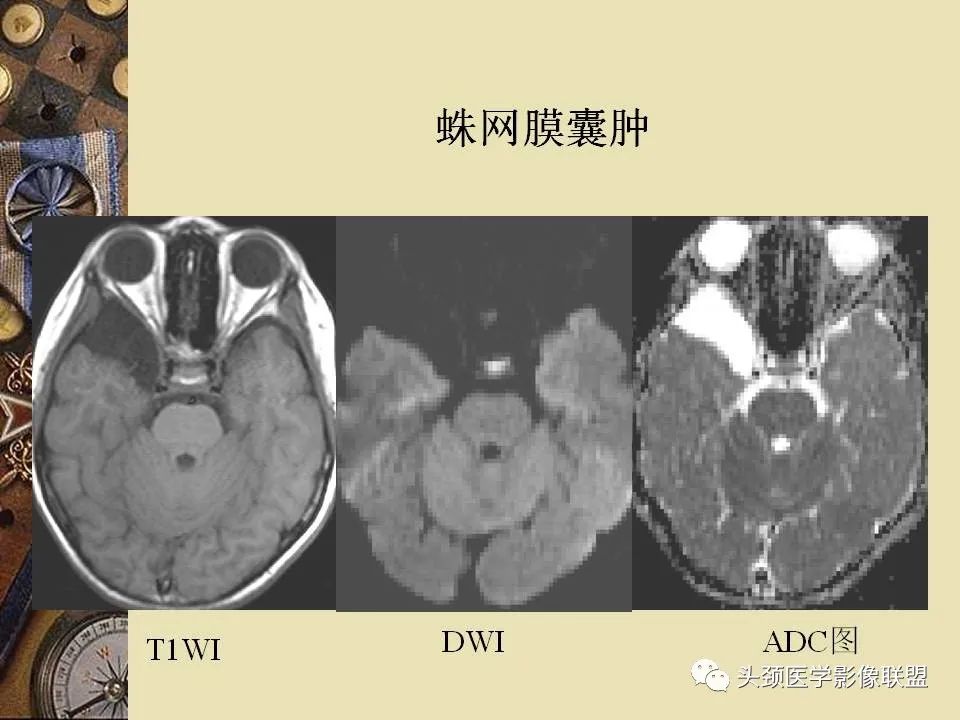 影像PPT - 【PPT】脑部病变的MRI诊断-117