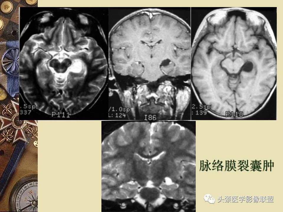 影像PPT - 【PPT】脑部病变的MRI诊断-118
