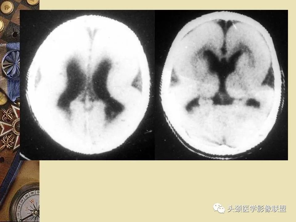 影像PPT - 【PPT】脑部病变的MRI诊断-121