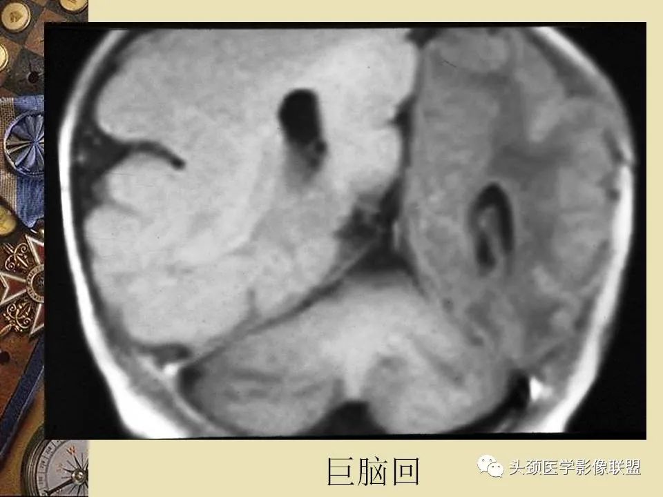 影像PPT - 【PPT】脑部病变的MRI诊断-124