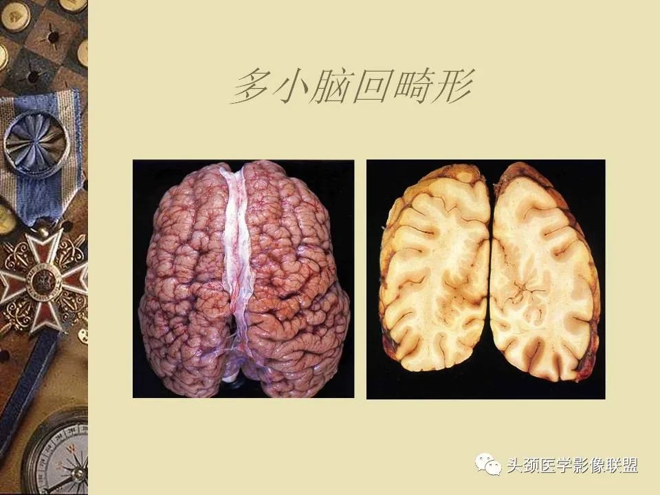 影像PPT - 【PPT】脑部病变的MRI诊断-125
