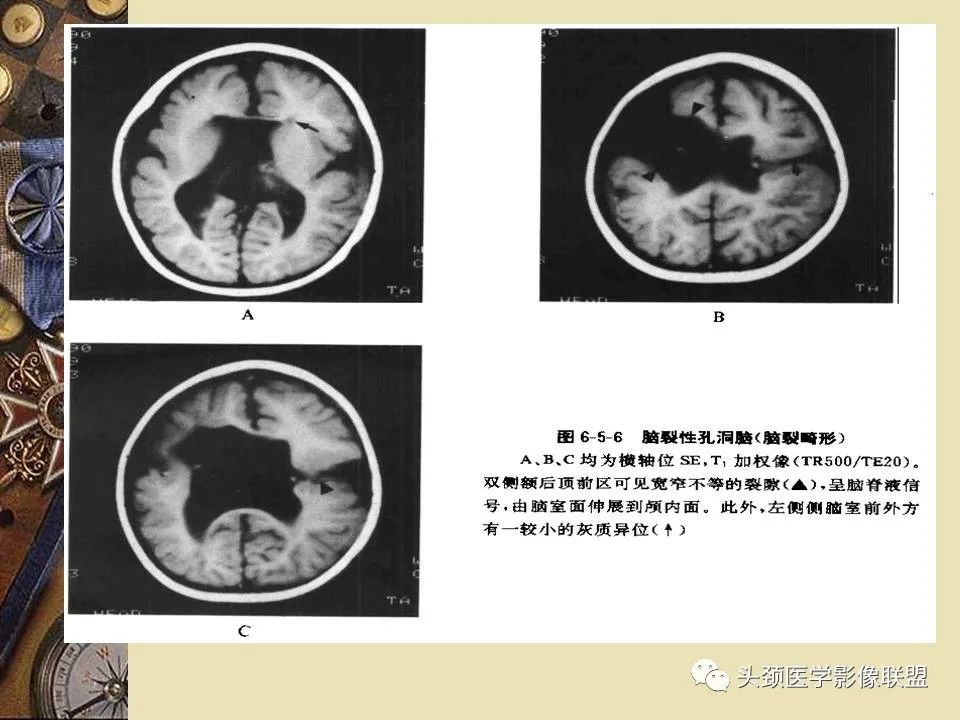 影像PPT - 【PPT】脑部病变的MRI诊断-123