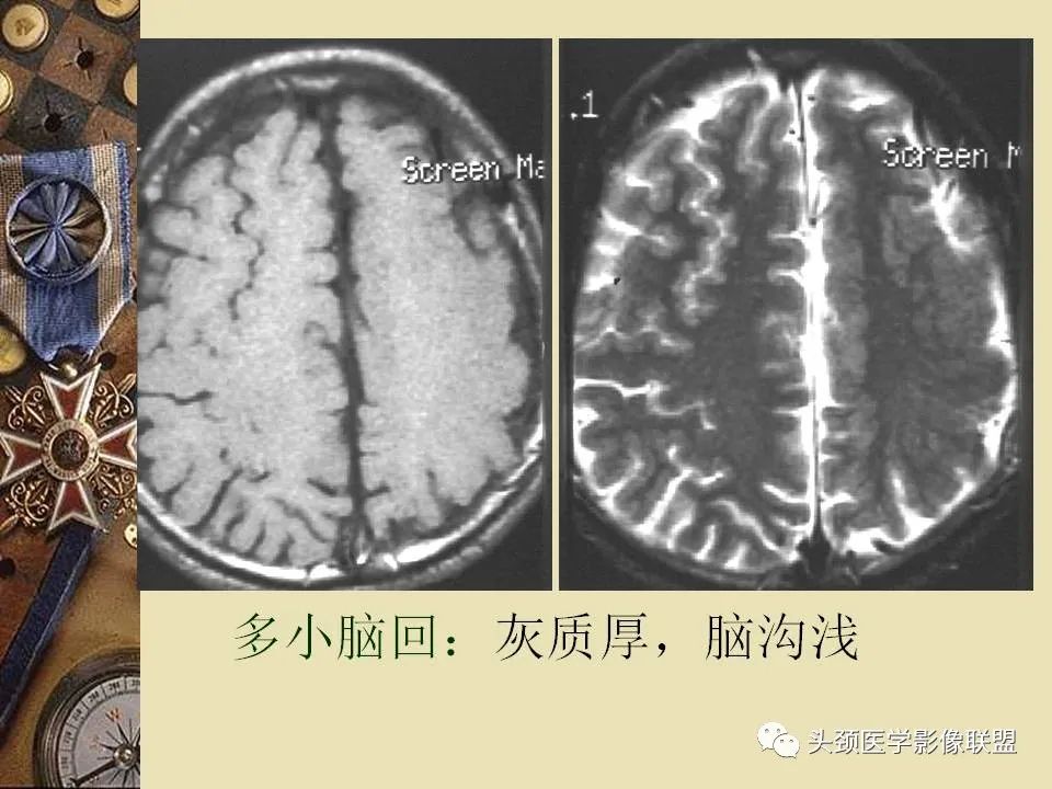 影像PPT - 【PPT】脑部病变的MRI诊断-126