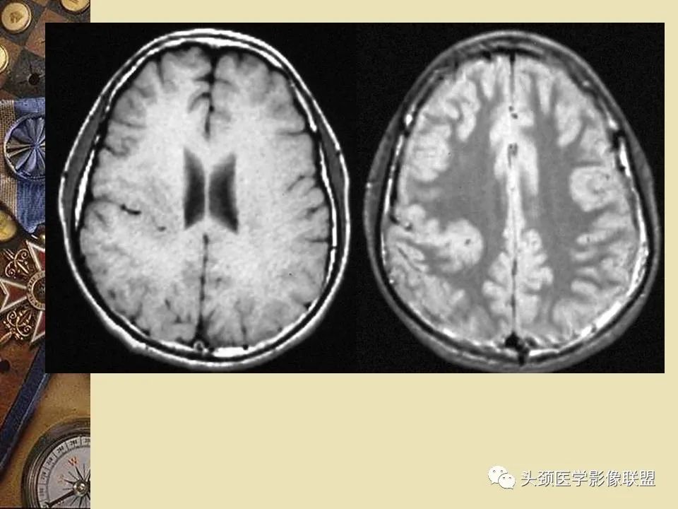 影像PPT - 【PPT】脑部病变的MRI诊断-128