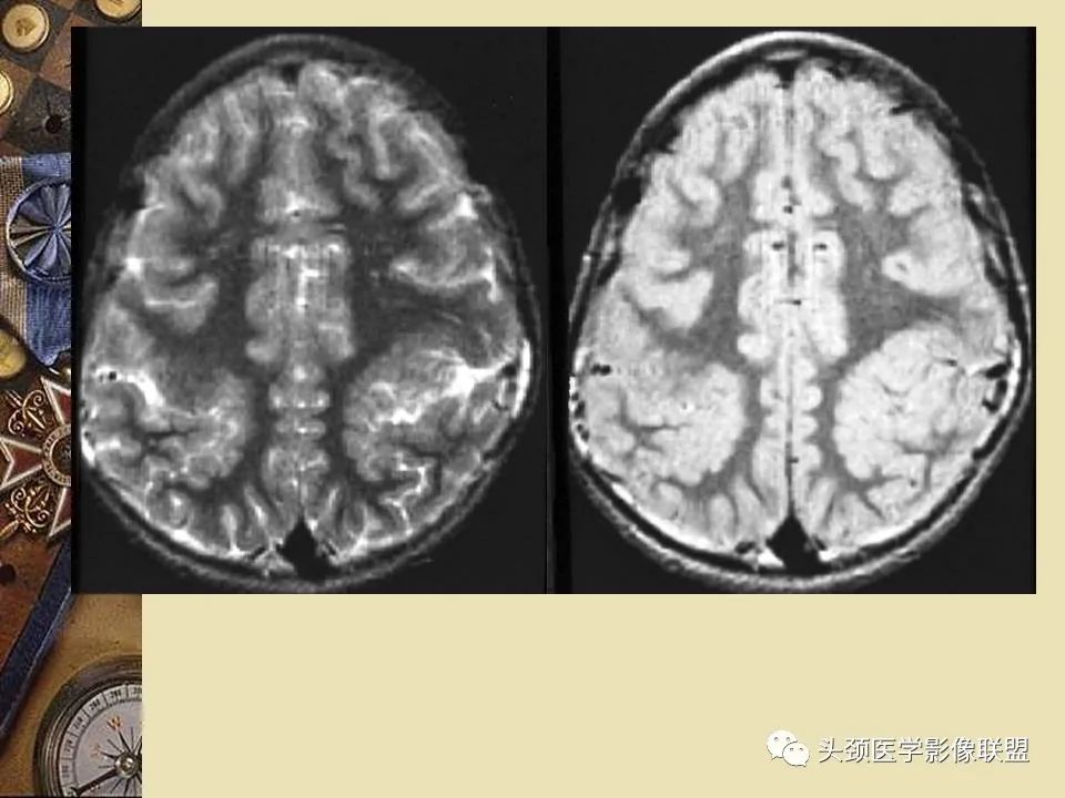 影像PPT - 【PPT】脑部病变的MRI诊断-129