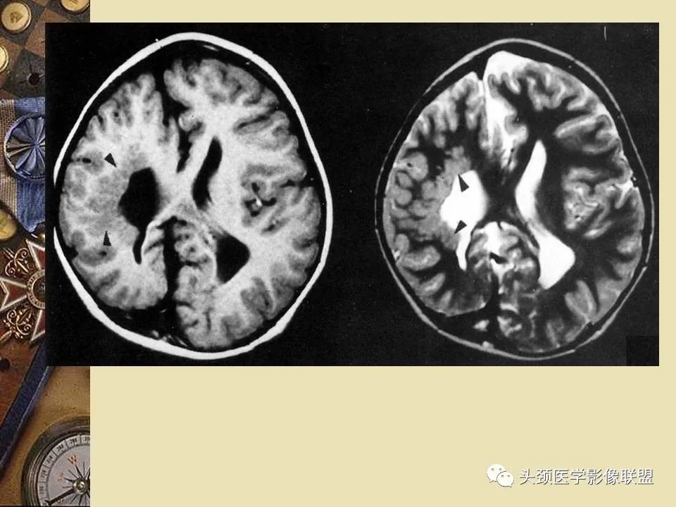 影像PPT - 【PPT】脑部病变的MRI诊断-130