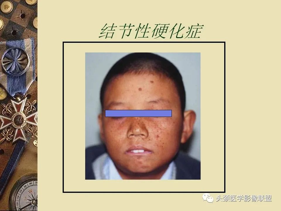 影像PPT - 【PPT】脑部病变的MRI诊断-133