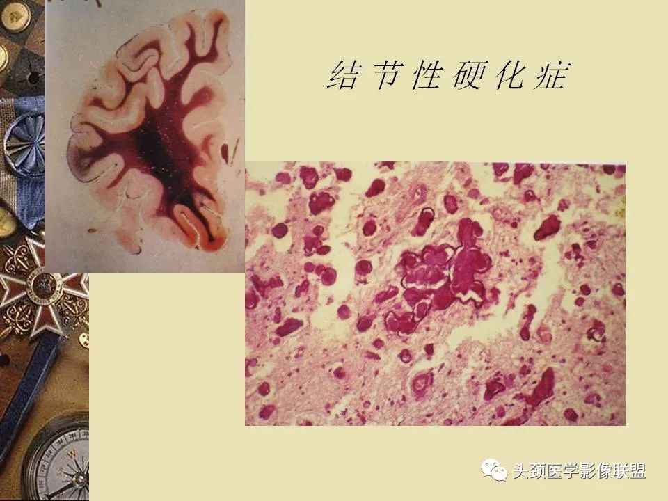 影像PPT - 【PPT】脑部病变的MRI诊断-134