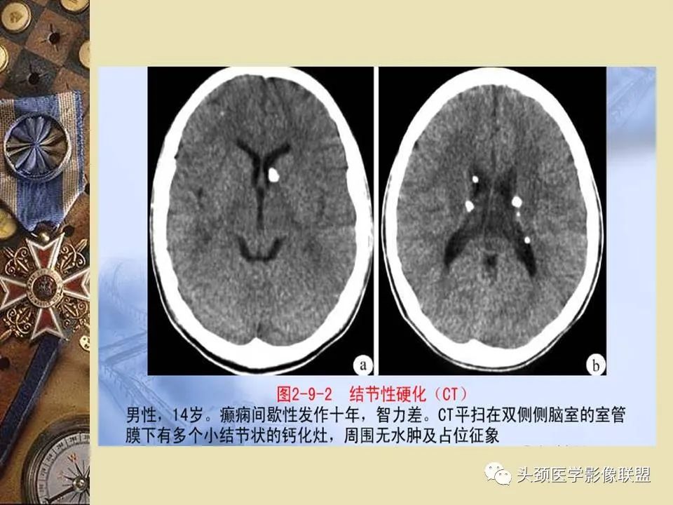 影像PPT - 【PPT】脑部病变的MRI诊断-135