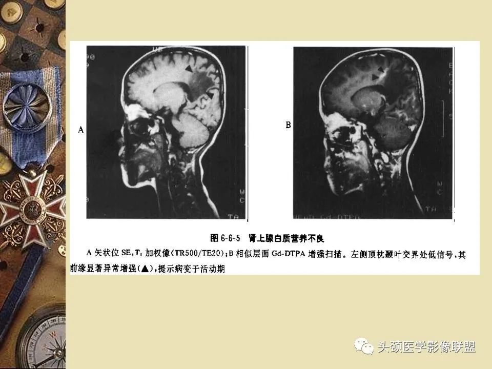 影像PPT - 【PPT】脑部病变的MRI诊断-146