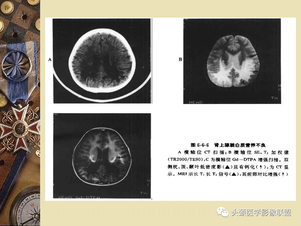 影像PPT - 【PPT】脑部病变的MRI诊断-147