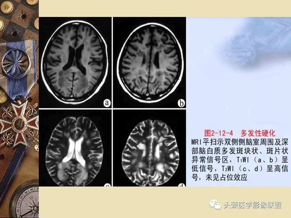 影像PPT - 【PPT】脑部病变的MRI诊断-155