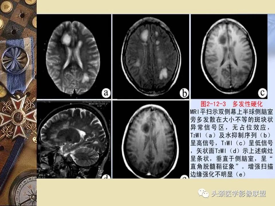 影像PPT - 【PPT】脑部病变的MRI诊断-156