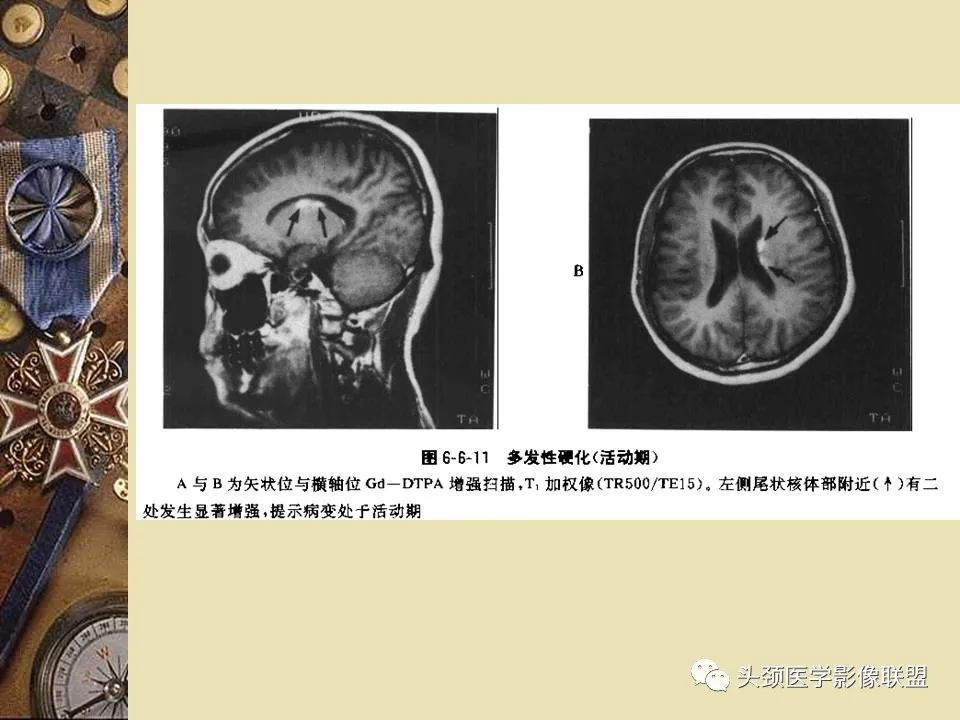 影像PPT - 【PPT】脑部病变的MRI诊断-157
