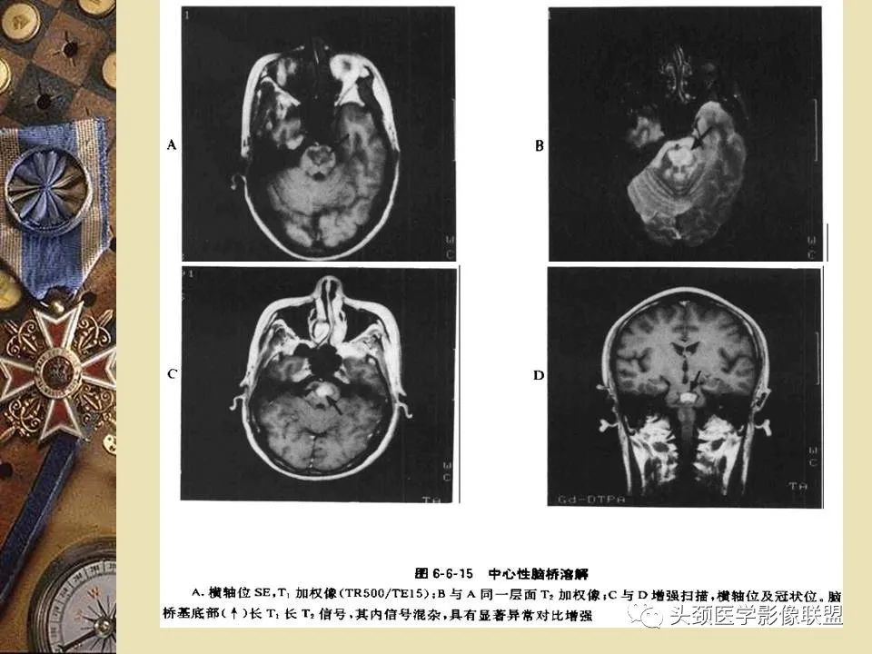 影像PPT - 【PPT】脑部病变的MRI诊断-161