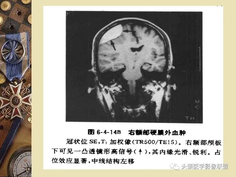 影像PPT - 【PPT】脑部病变的MRI诊断-164