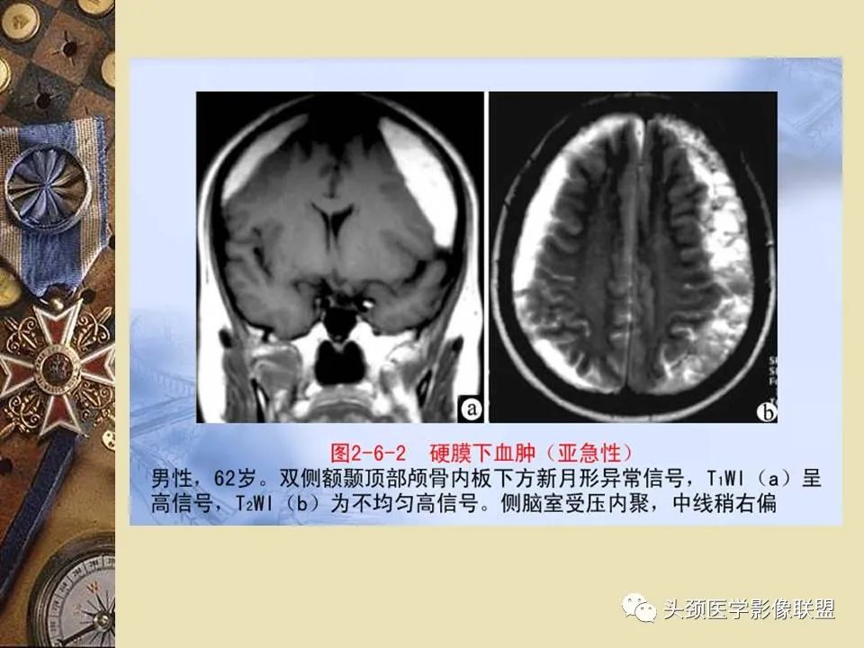 影像PPT - 【PPT】脑部病变的MRI诊断-165