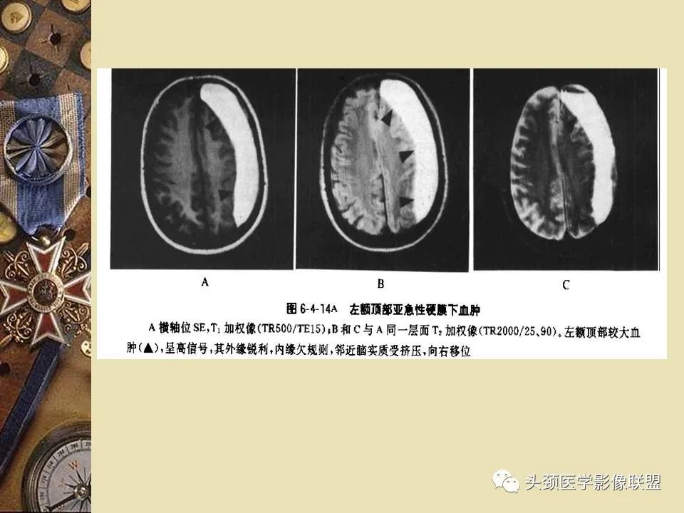 影像PPT - 【PPT】脑部病变的MRI诊断-166