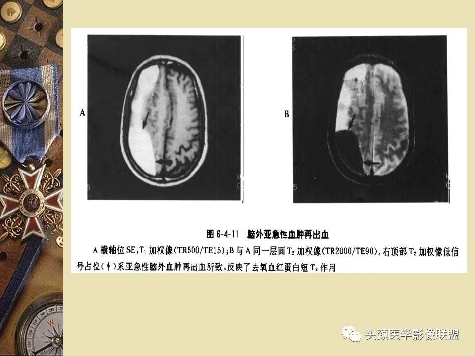影像PPT - 【PPT】脑部病变的MRI诊断-167