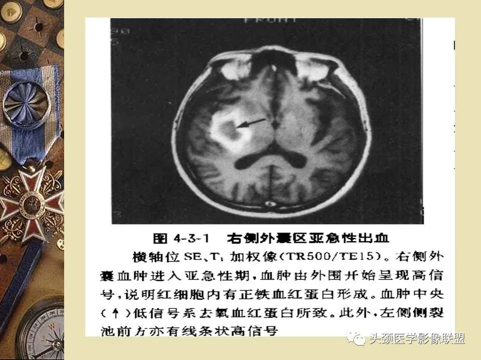 影像PPT - 【PPT】脑部病变的MRI诊断-169