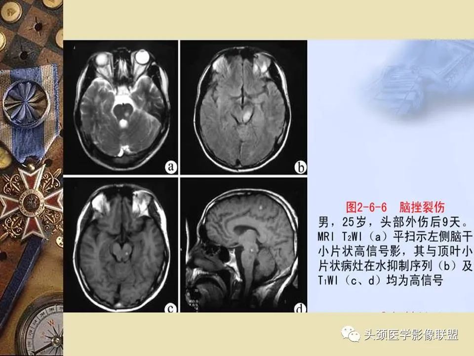 影像PPT - 【PPT】脑部病变的MRI诊断-171