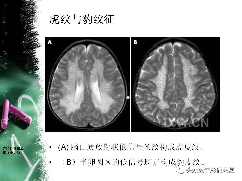 影像PPT - 【PPT】影像异常征象—神经科常见影像征象-2