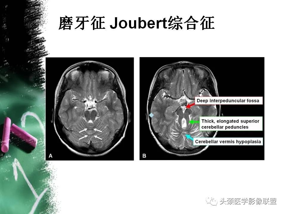 影像PPT - 【PPT】影像异常征象—神经科常见影像征象-3