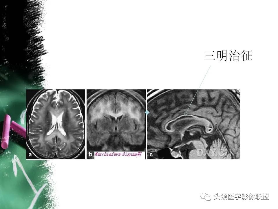 影像PPT - 【PPT】影像异常征象—神经科常见影像征象-4