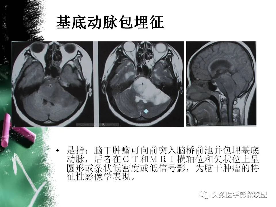 影像PPT - 【PPT】影像异常征象—神经科常见影像征象-6