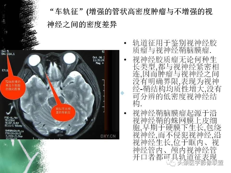 影像PPT - 【PPT】影像异常征象—神经科常见影像征象-5