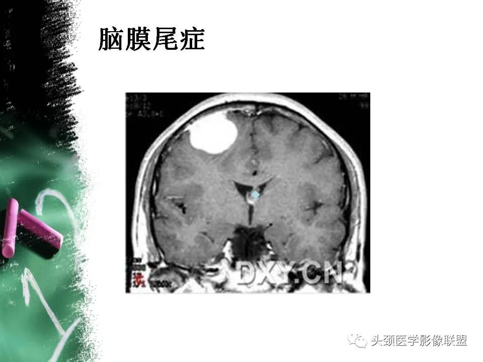 影像PPT - 【PPT】影像异常征象—神经科常见影像征象-7