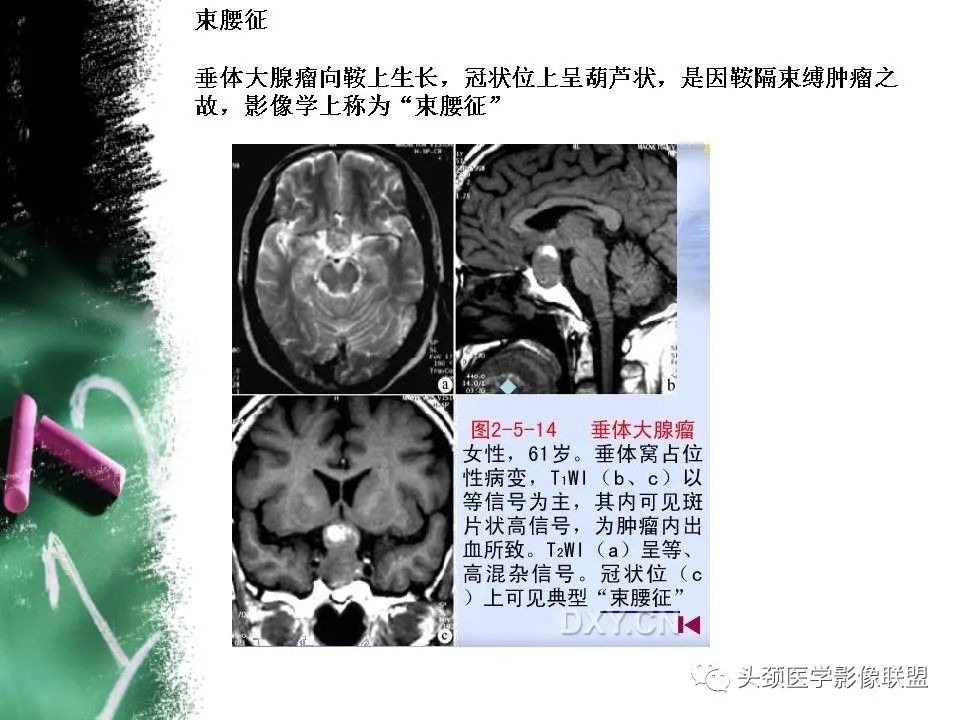 影像PPT - 【PPT】影像异常征象—神经科常见影像征象-8