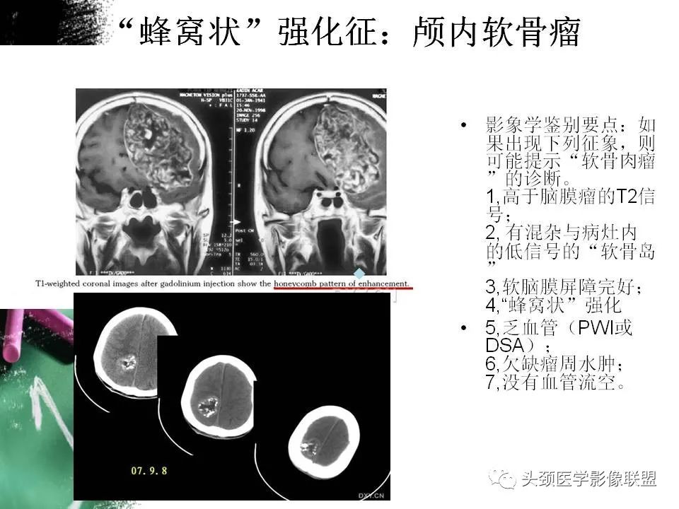 影像PPT - 【PPT】影像异常征象—神经科常见影像征象-9