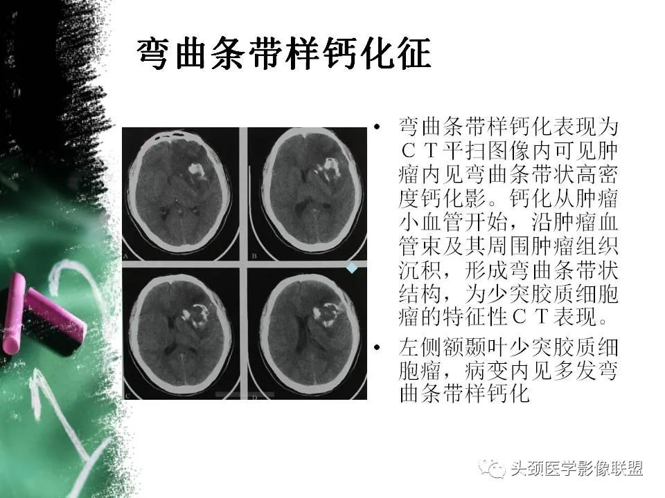 影像PPT - 【PPT】影像异常征象—神经科常见影像征象-10