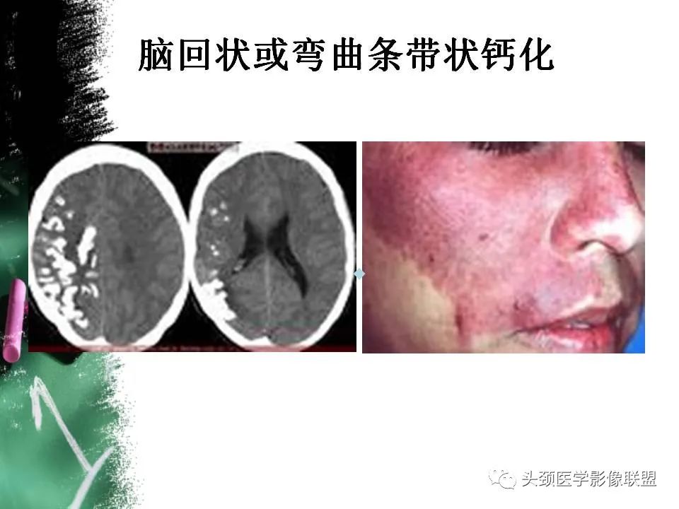 影像PPT - 【PPT】影像异常征象—神经科常见影像征象-11