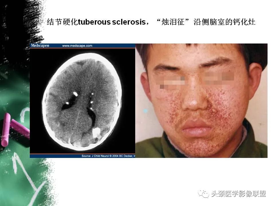 影像PPT - 【PPT】影像异常征象—神经科常见影像征象-12
