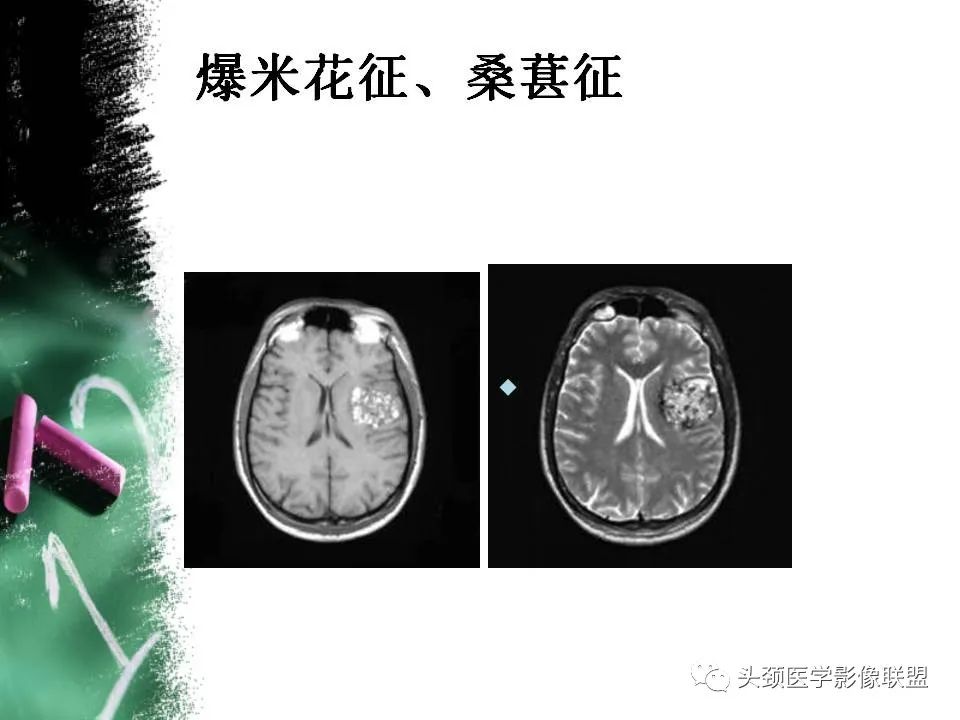 影像PPT - 【PPT】影像异常征象—神经科常见影像征象-13